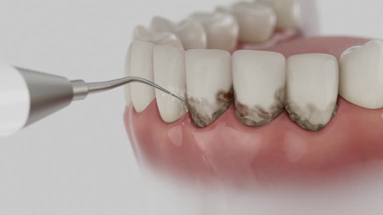 Reliable Dental Implants contractor in Lauderhill, FL by Smile Center Dentistry